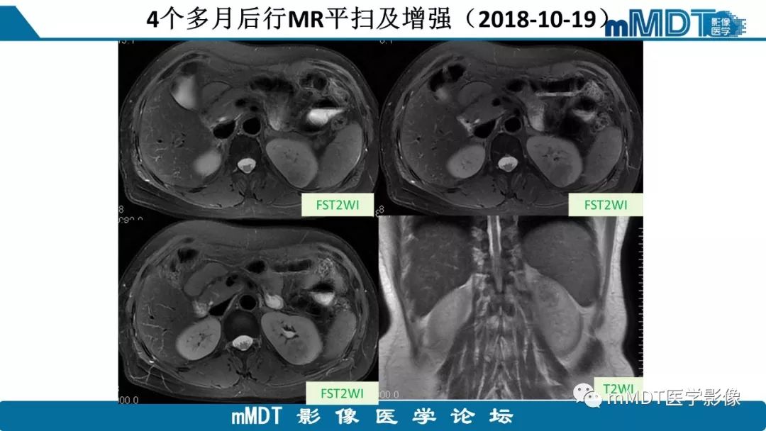 【病例】肾脏嫌色细胞癌1例CT及MR