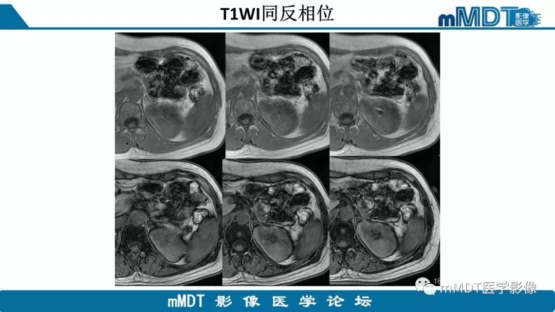 【病例】肾脏嫌色细胞癌1例CT及MR