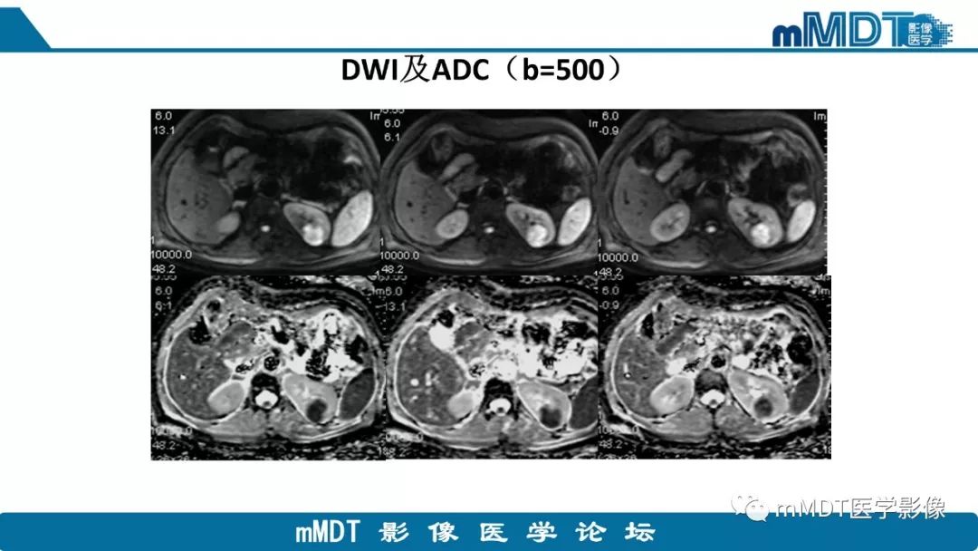 【病例】肾脏嫌色细胞癌1例CT及MR