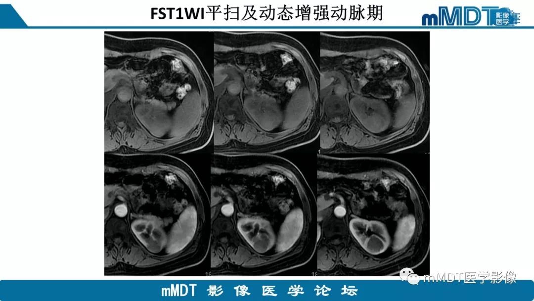 【病例】肾脏嫌色细胞癌1例CT及MR