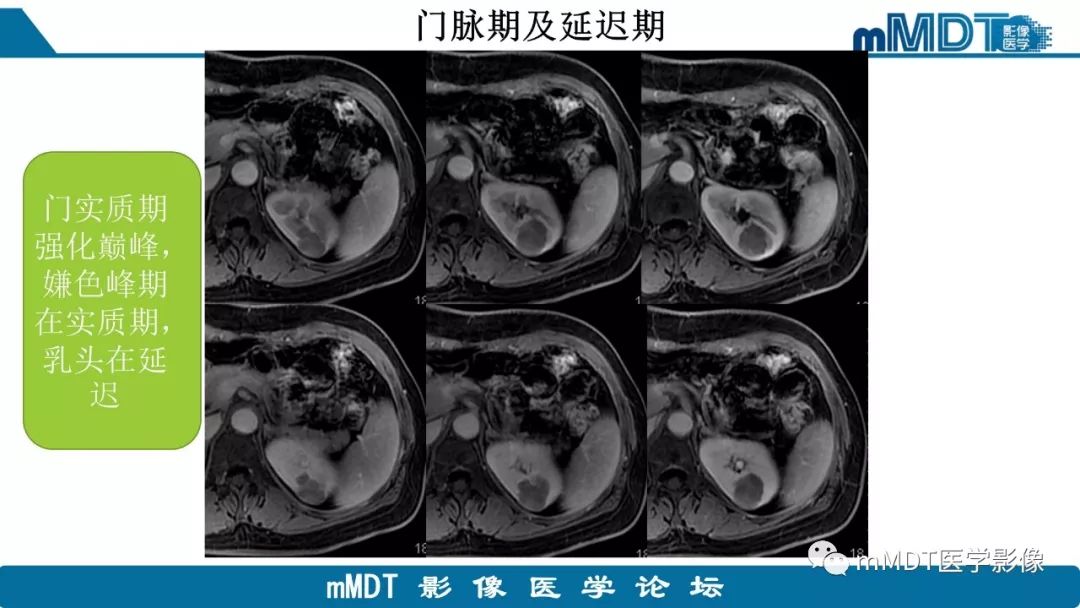 【病例】肾脏嫌色细胞癌1例CT及MR