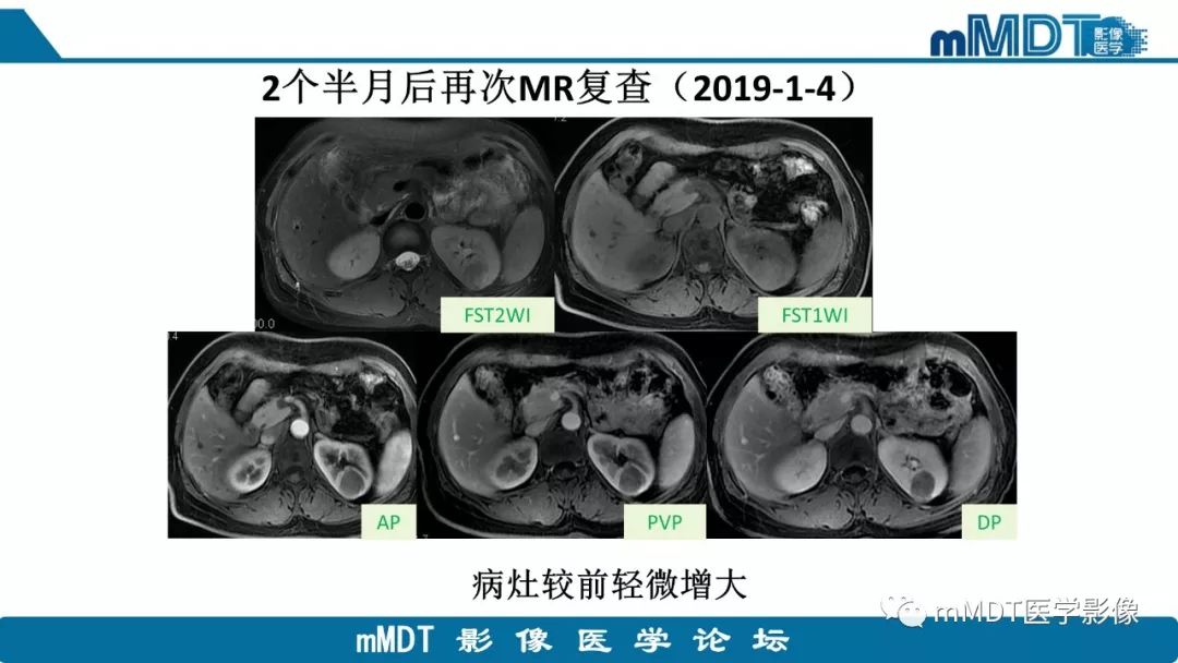 【病例】肾脏嫌色细胞癌1例CT及MR