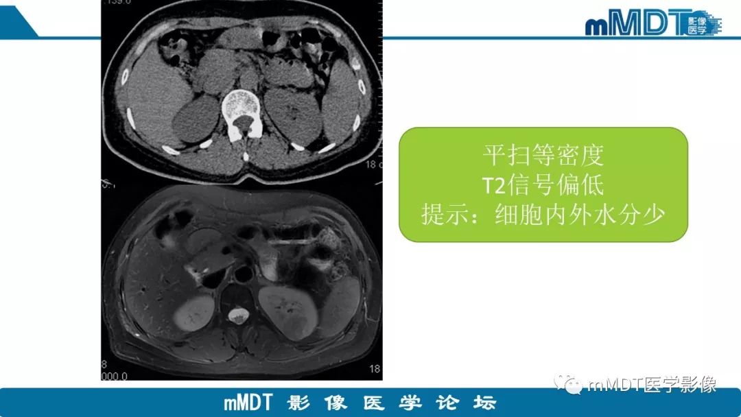 【病例】肾脏嫌色细胞癌1例CT及MR
