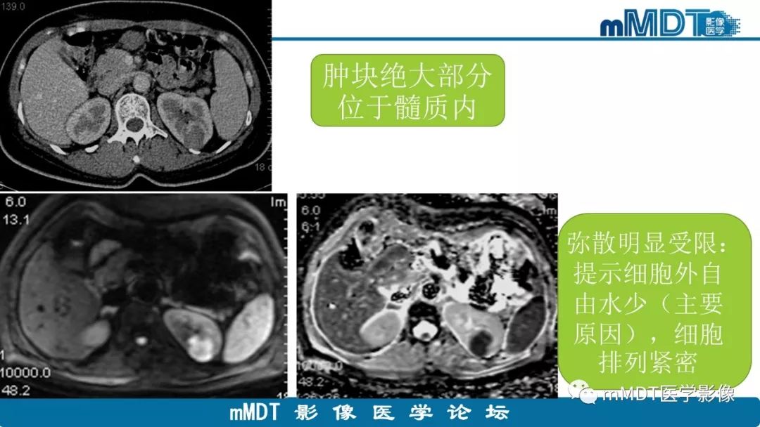 【病例】肾脏嫌色细胞癌1例CT及MR