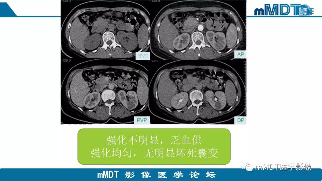 【病例】肾脏嫌色细胞癌1例CT及MR
