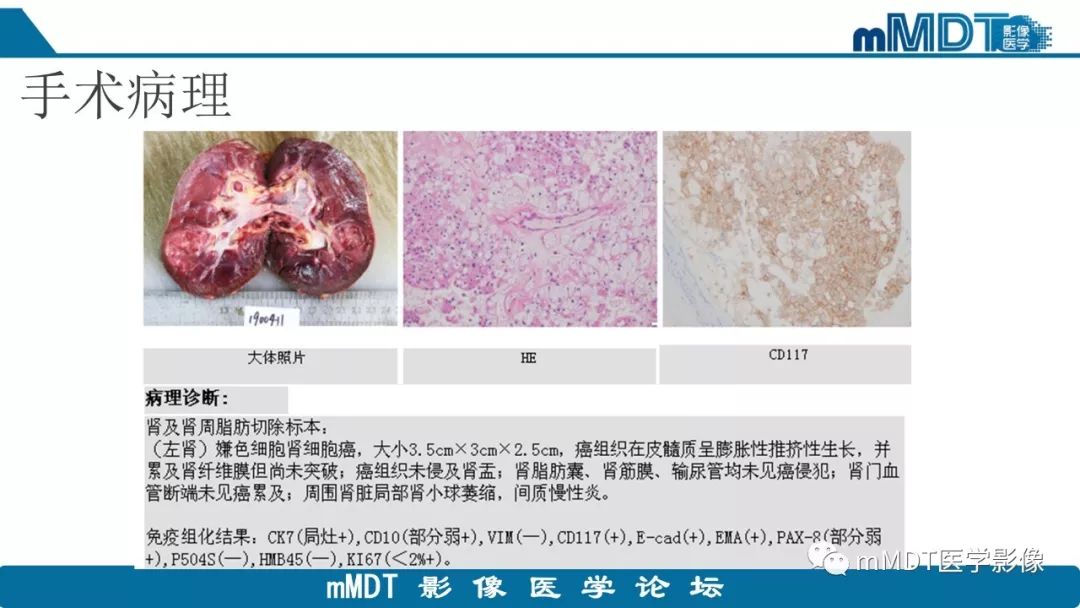 【病例】肾脏嫌色细胞癌1例CT及MR