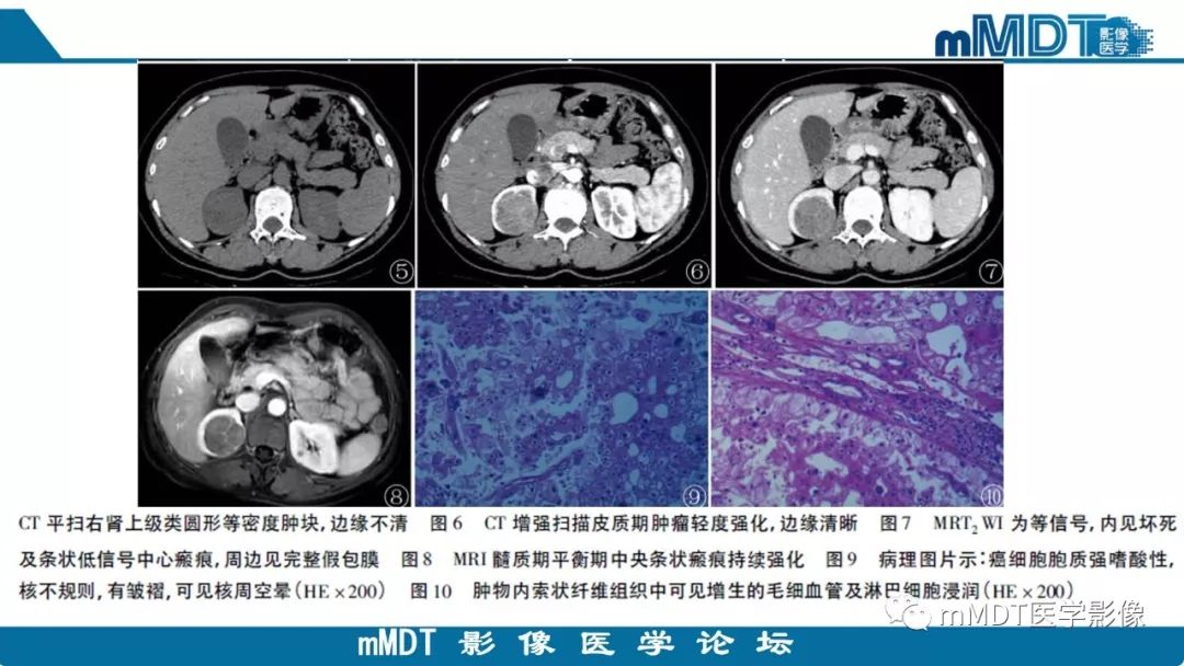 【病例】肾脏嫌色细胞癌1例CT及MR