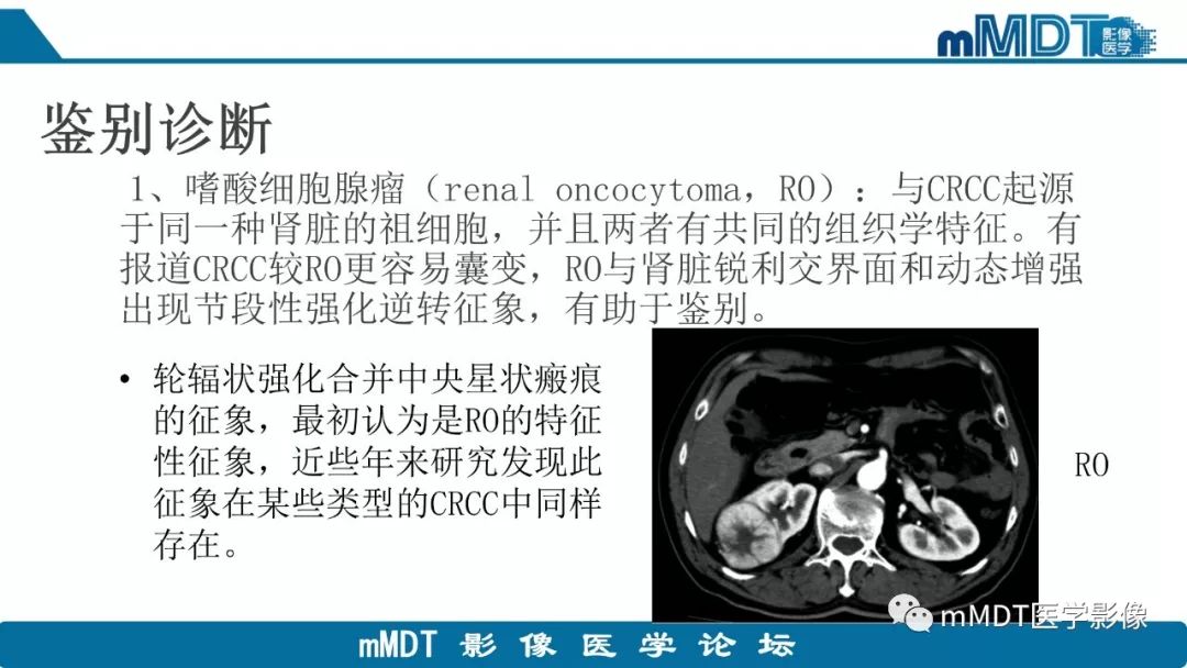 【病例】肾脏嫌色细胞癌1例CT及MR
