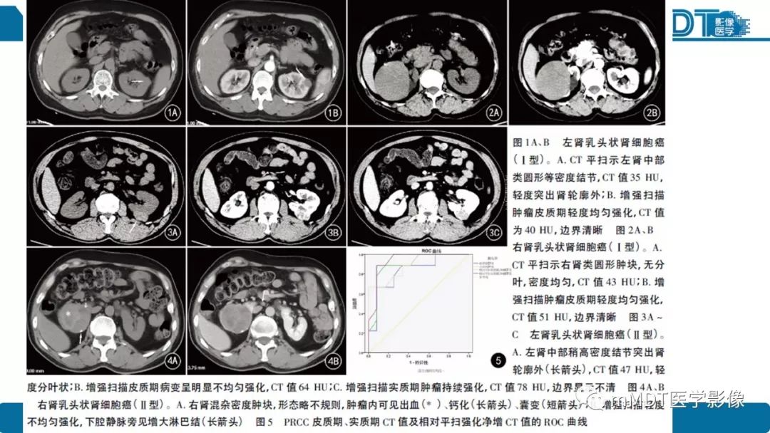 【病例】肾脏嫌色细胞癌1例CT及MR