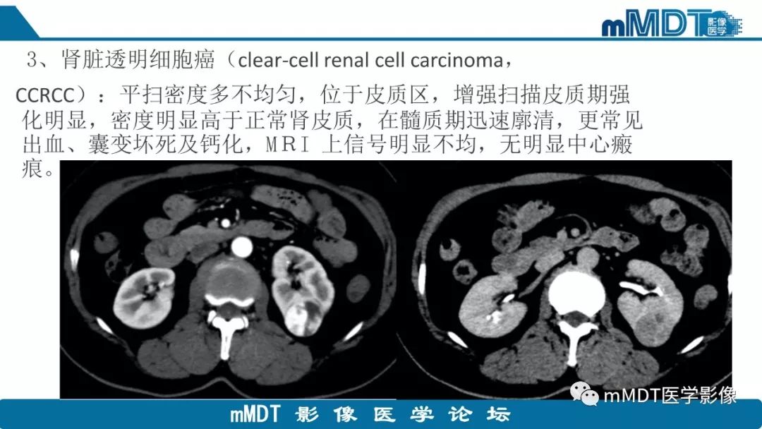 【病例】肾脏嫌色细胞癌1例CT及MR