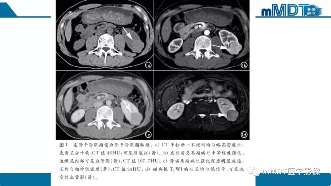 【病例】肾脏嫌色细胞癌1例CT及MR