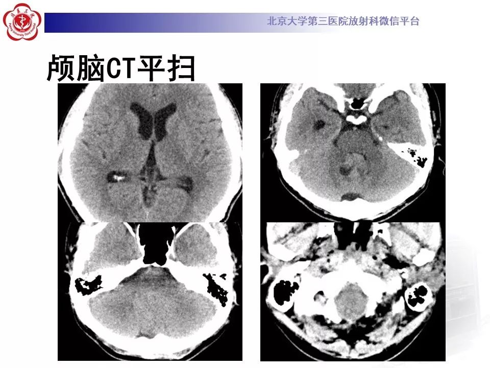 【病例】四脑室室管膜瘤1例CT及MR