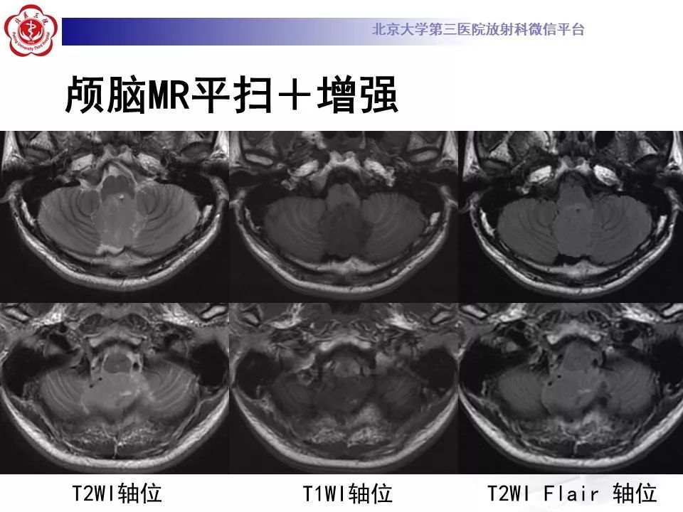 【病例】四脑室室管膜瘤1例CT及MR