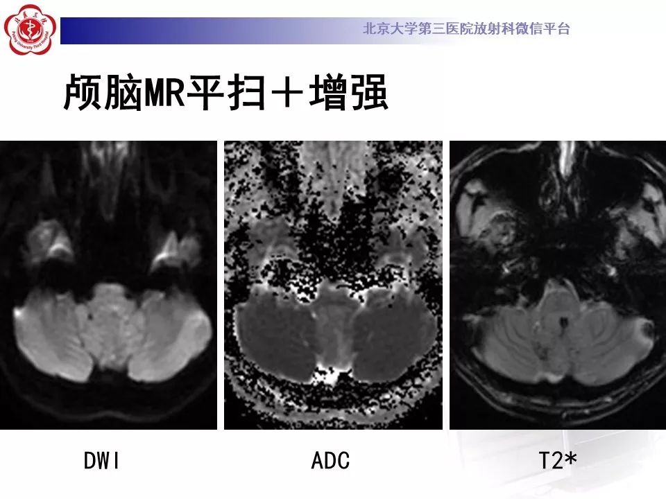 【病例】四脑室室管膜瘤1例CT及MR