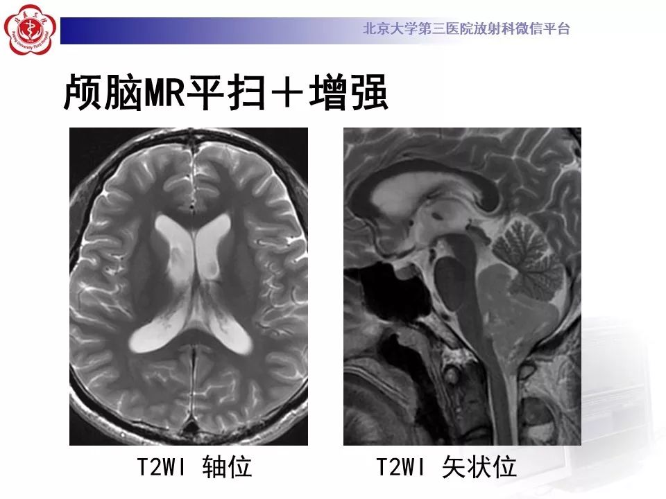 【病例】四脑室室管膜瘤1例CT及MR