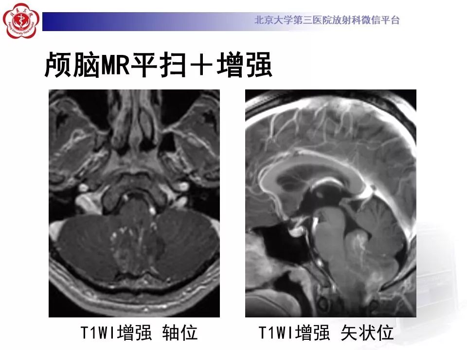 【病例】四脑室室管膜瘤1例CT及MR
