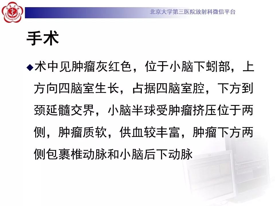 【病例】四脑室室管膜瘤1例CT及MR