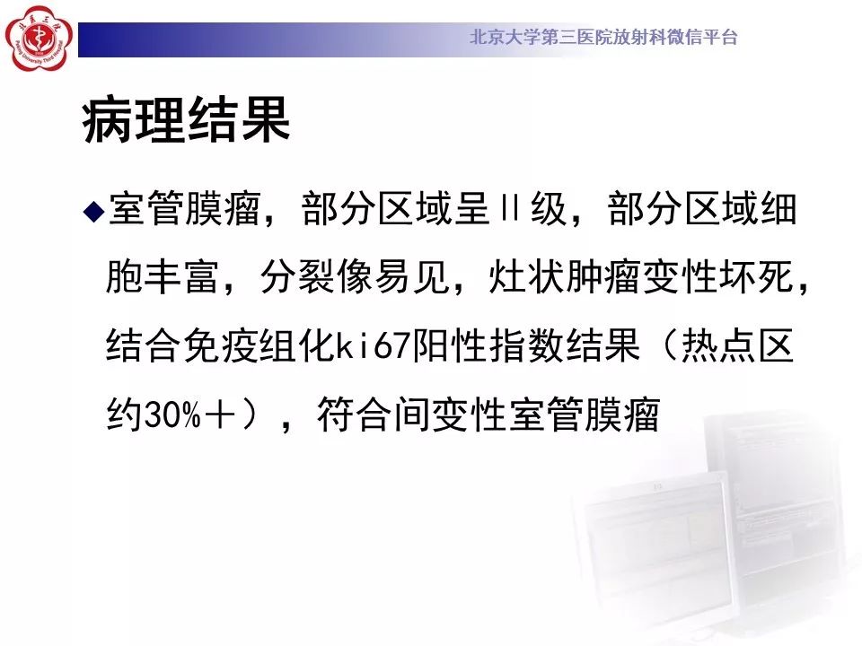 【病例】四脑室室管膜瘤1例CT及MR