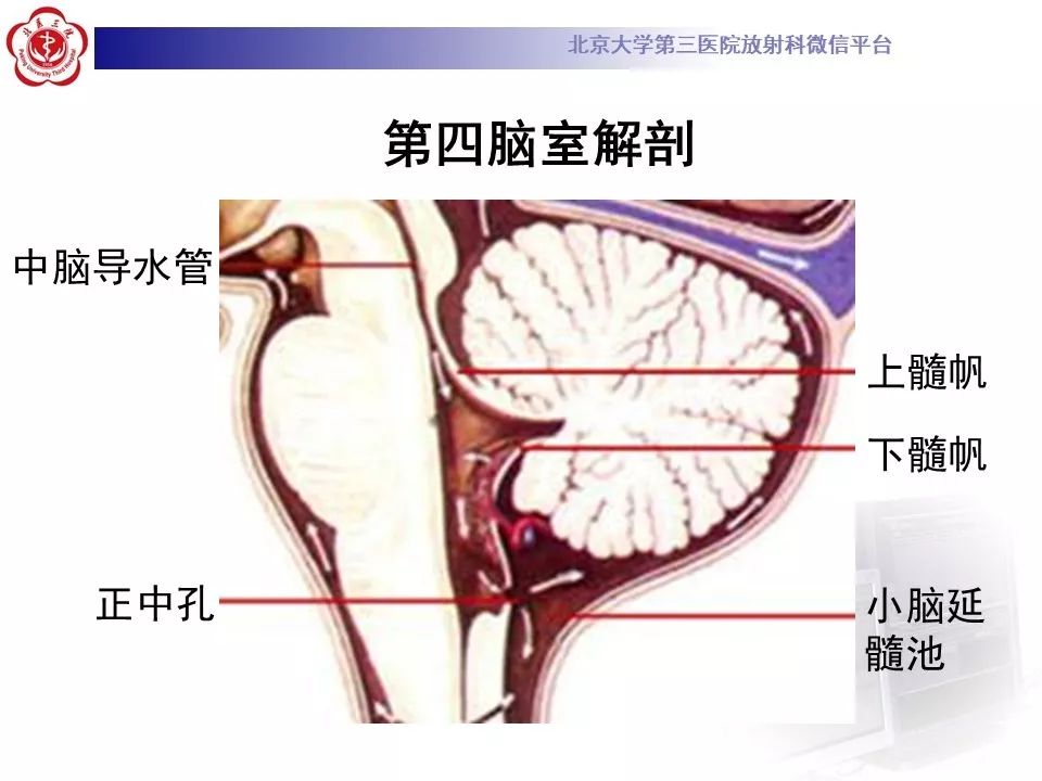 【病例】四脑室室管膜瘤1例CT及MR