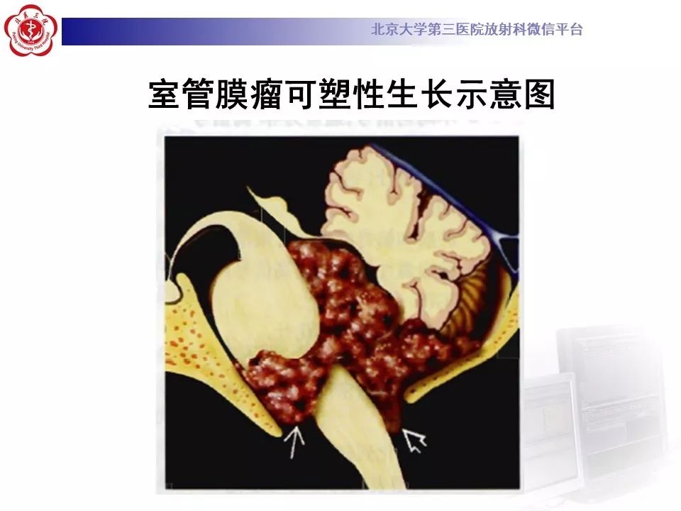 【病例】四脑室室管膜瘤1例CT及MR