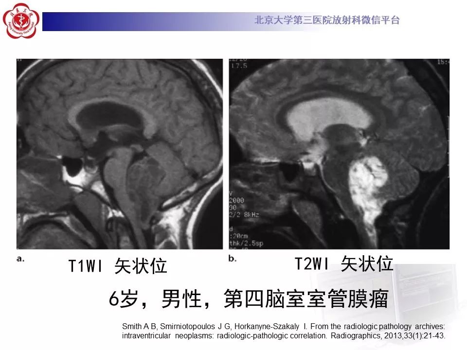 【病例】四脑室室管膜瘤1例CT及MR