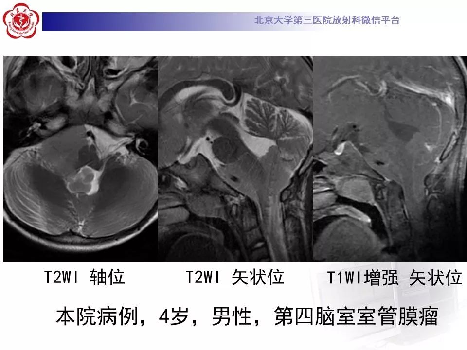 【病例】四脑室室管膜瘤1例CT及MR