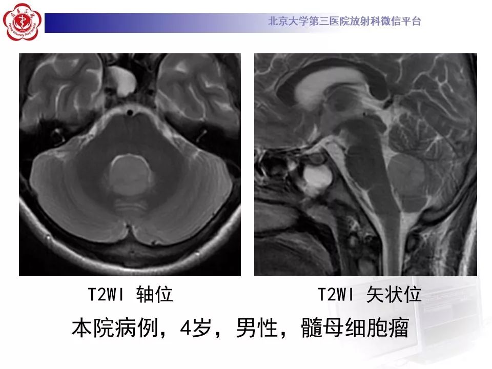 【病例】四脑室室管膜瘤1例CT及MR