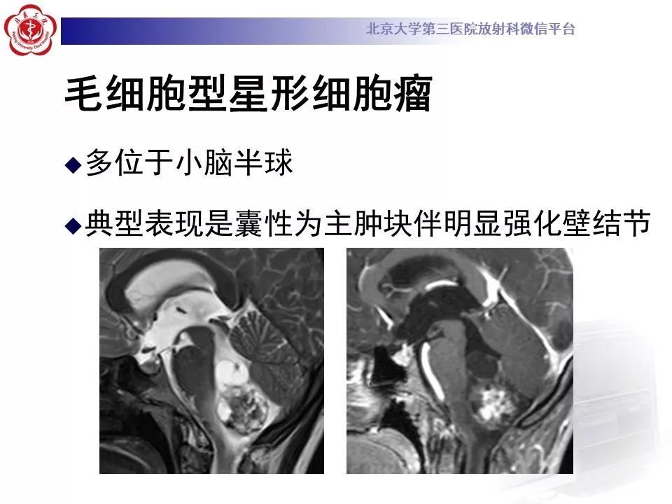 【病例】四脑室室管膜瘤1例CT及MR