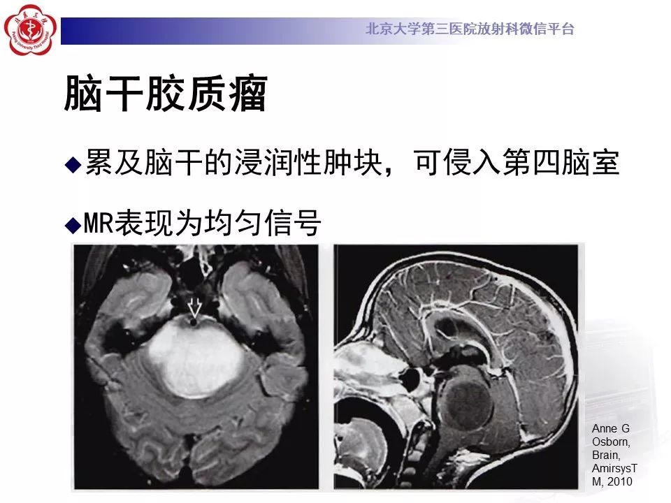【病例】四脑室室管膜瘤1例CT及MR