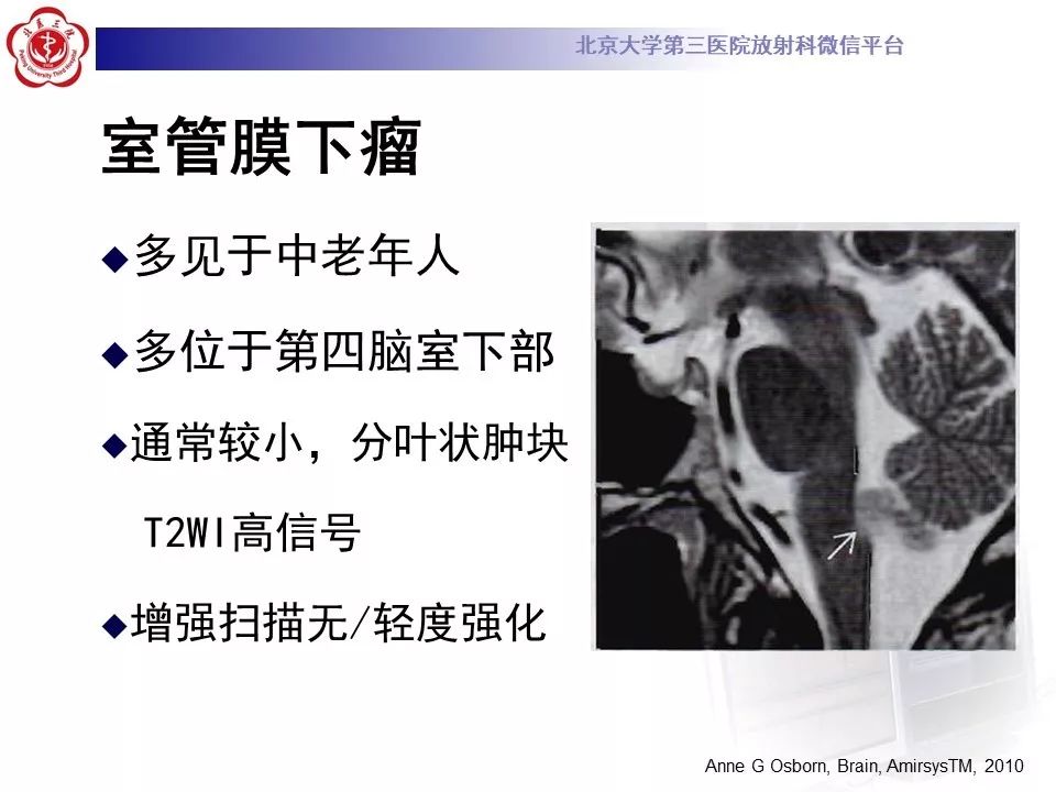 【病例】四脑室室管膜瘤1例CT及MR