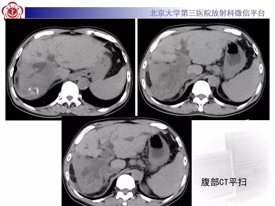 【病例】肝内胆管导管内乳头状肿瘤1例CT及MR