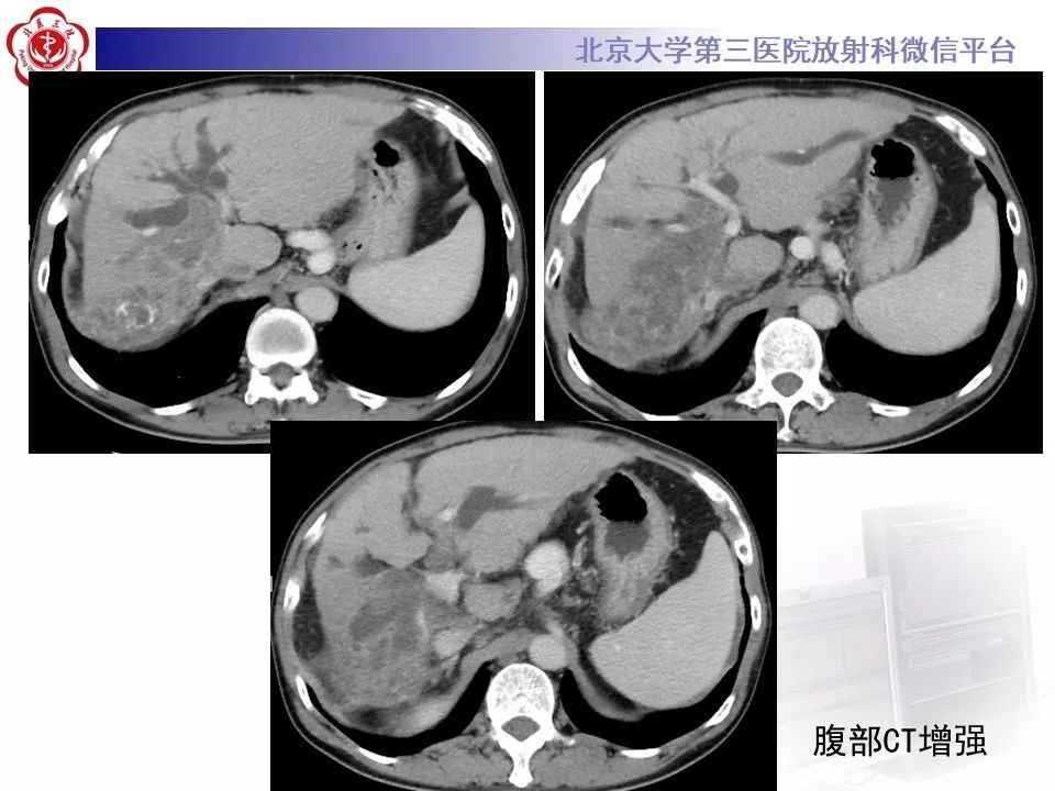 【病例】肝内胆管导管内乳头状肿瘤1例CT及MR