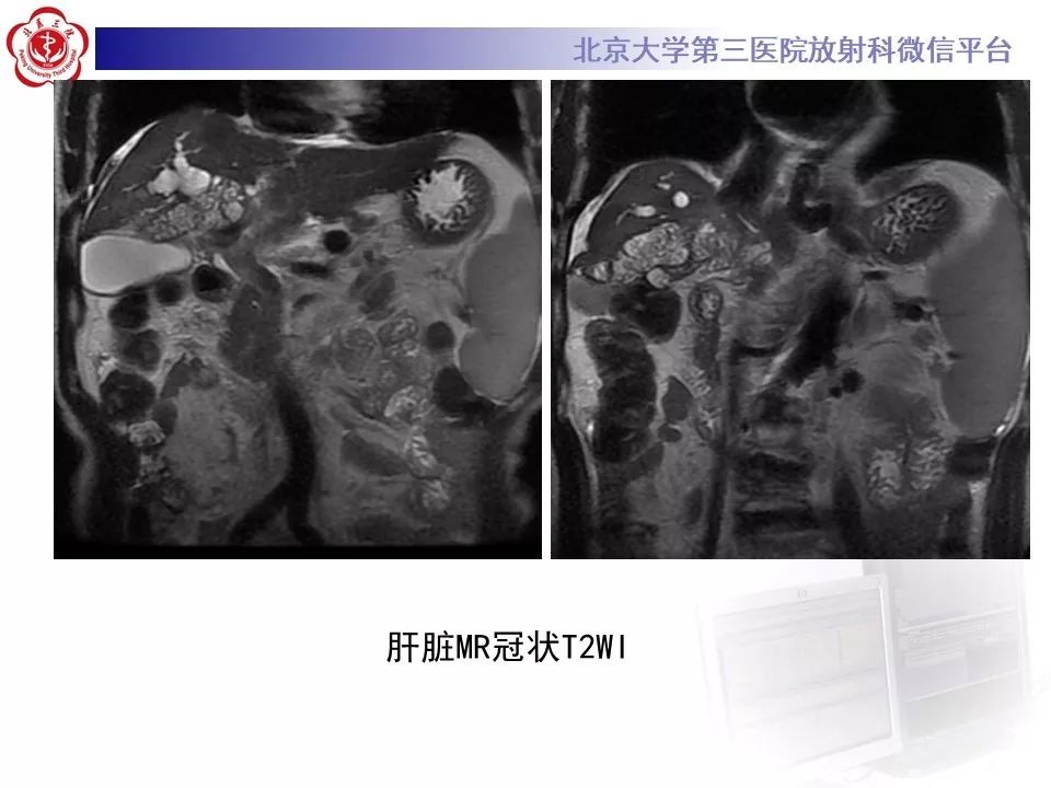 【病例】肝内胆管导管内乳头状肿瘤1例CT及MR