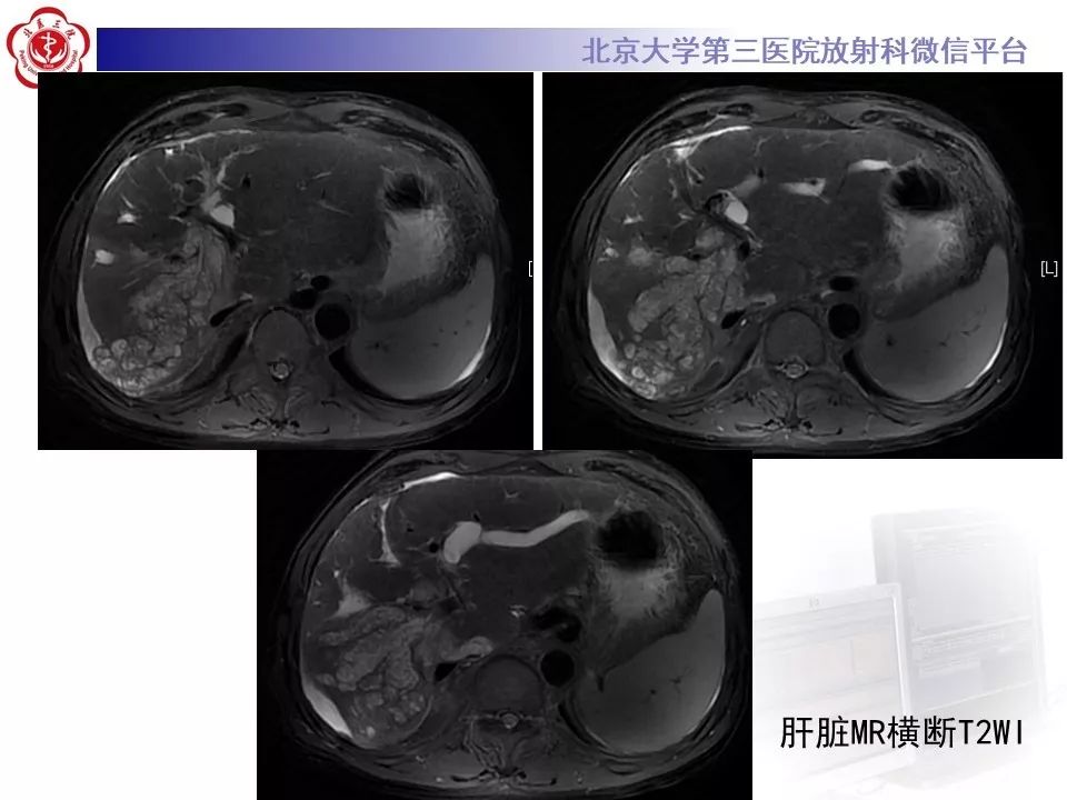 【病例】肝内胆管导管内乳头状肿瘤1例CT及MR