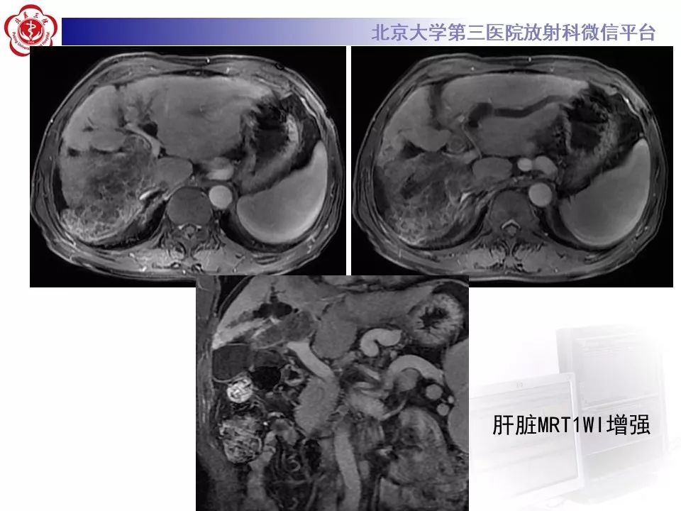 【病例】肝内胆管导管内乳头状肿瘤1例CT及MR