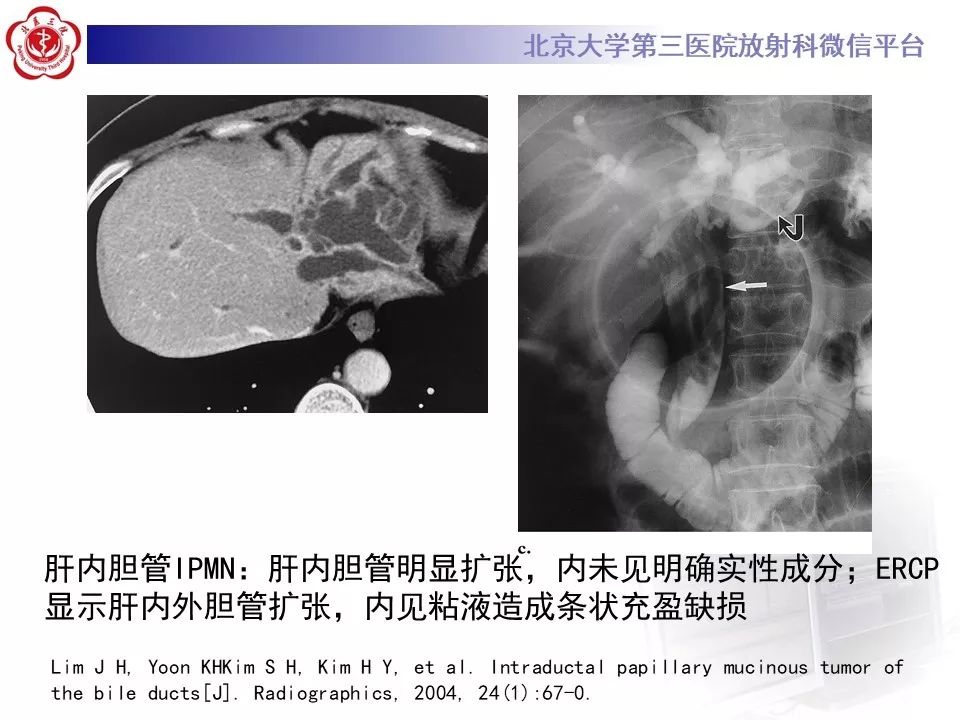 【病例】肝内胆管导管内乳头状肿瘤1例CT及MR