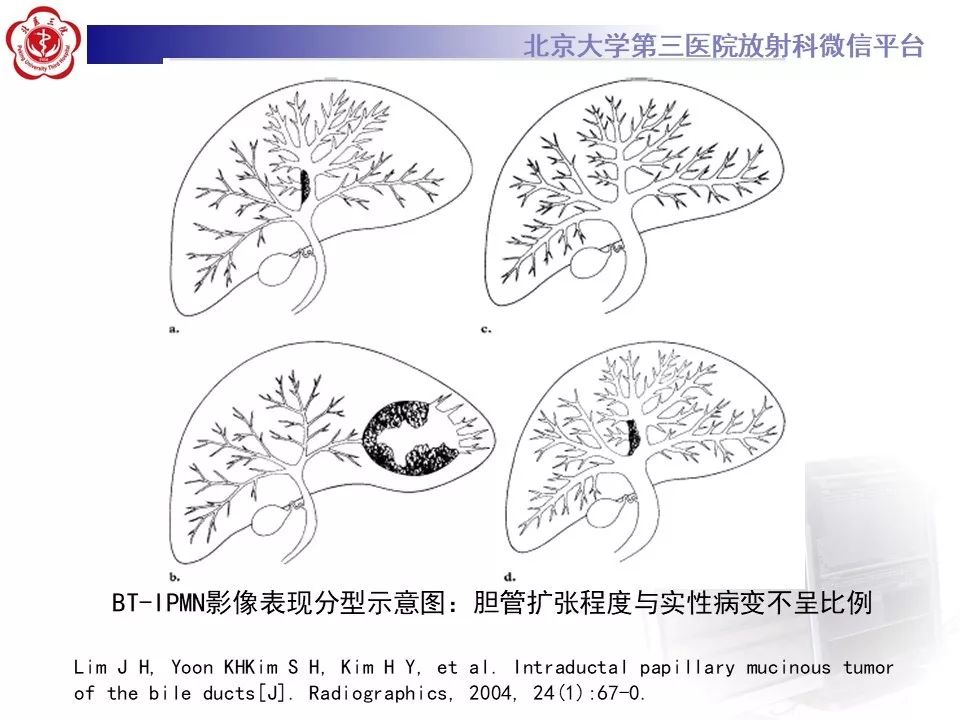 【病例】肝内胆管导管内乳头状肿瘤1例CT及MR
