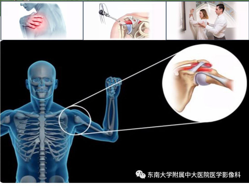 【PPT】肩关节病变影像诊断分析