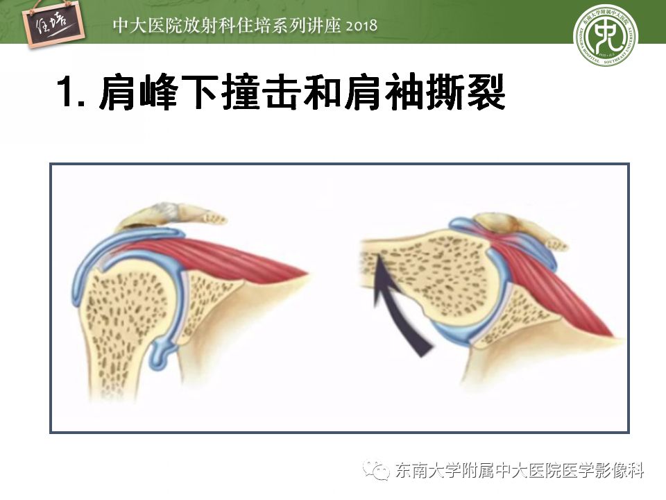 【PPT】肩关节病变影像诊断分析