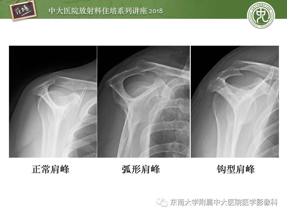【PPT】肩关节病变影像诊断分析
