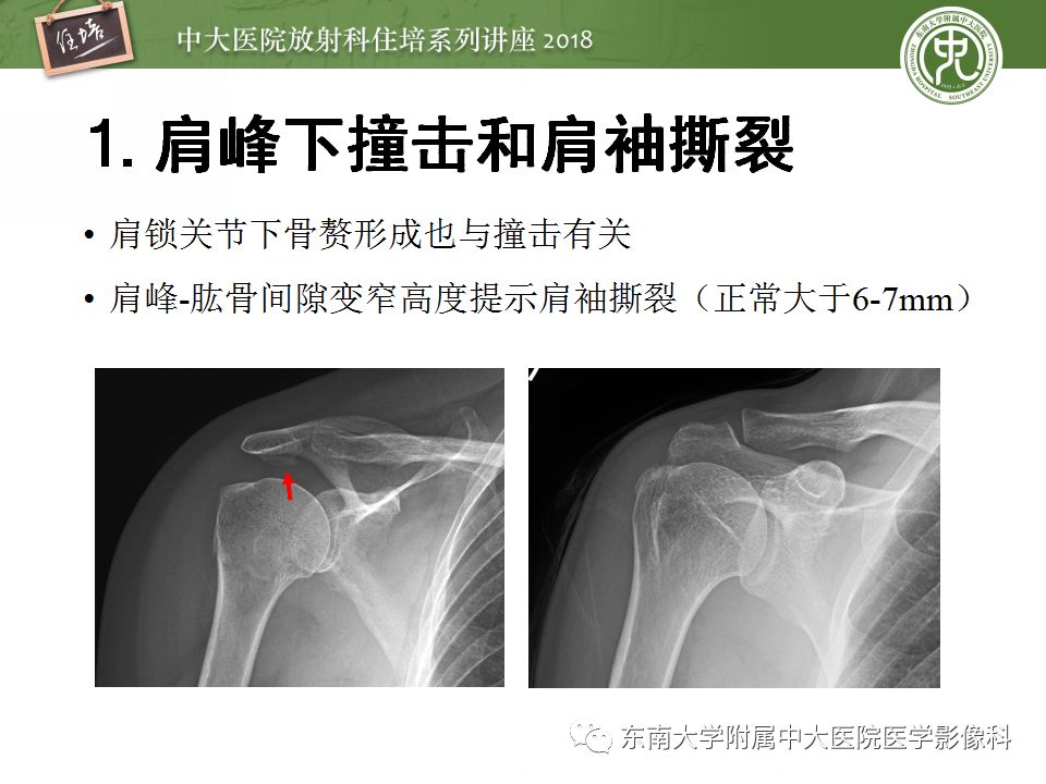 【PPT】肩关节病变影像诊断分析