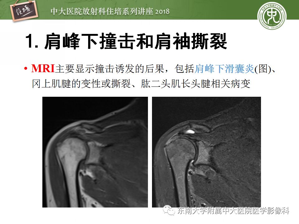 【PPT】肩关节病变影像诊断分析