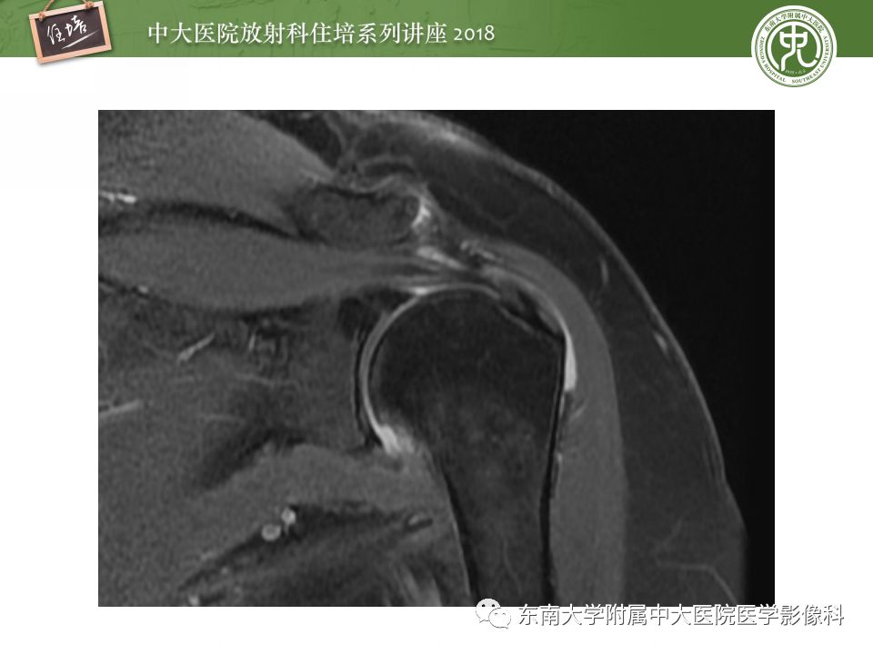 【PPT】肩关节病变影像诊断分析