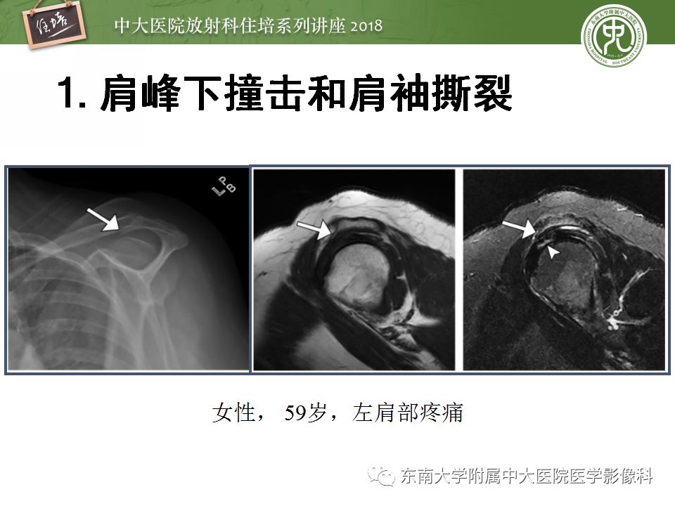 【PPT】肩关节病变影像诊断分析