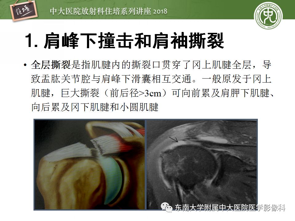 【PPT】肩关节病变影像诊断分析
