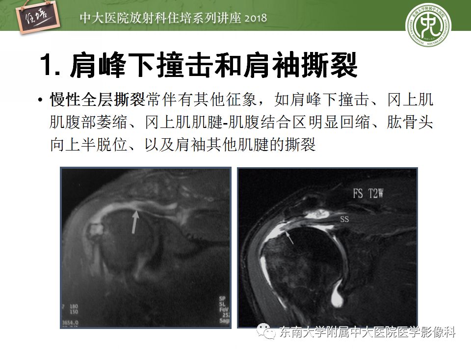 【PPT】肩关节病变影像诊断分析