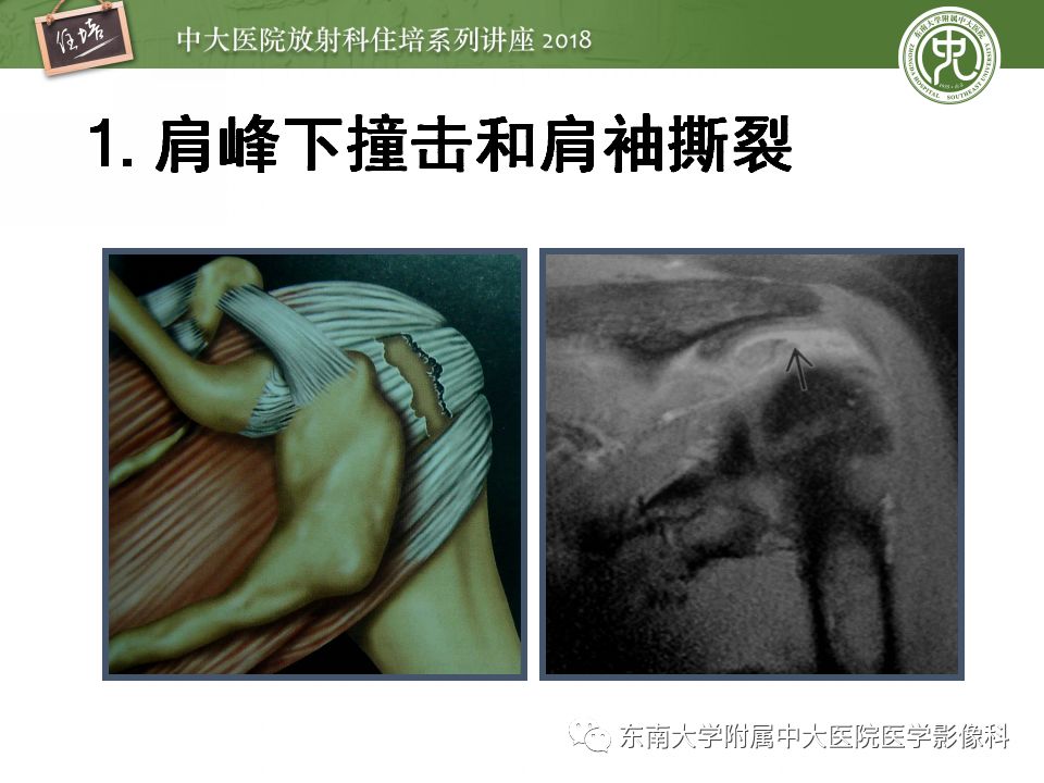 【PPT】肩关节病变影像诊断分析