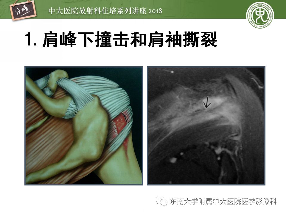 【PPT】肩关节病变影像诊断分析