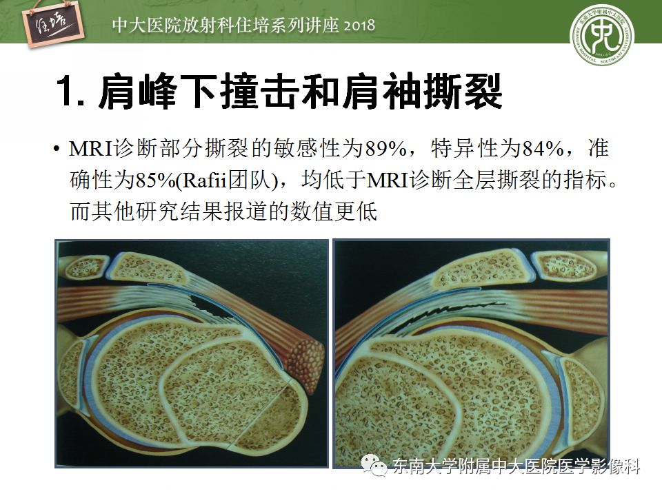 【PPT】肩关节病变影像诊断分析