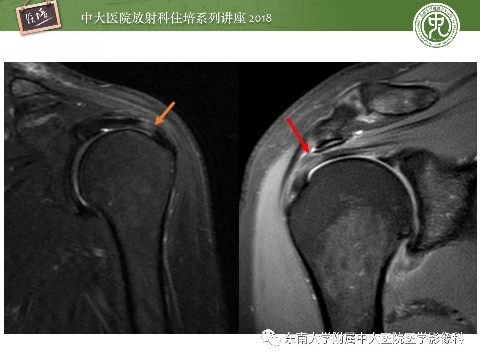 【PPT】肩关节病变影像诊断分析